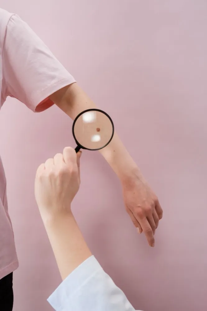 Lunares: Cuándo Preocuparse y Cómo Detectar el Melanoma a Tiempo