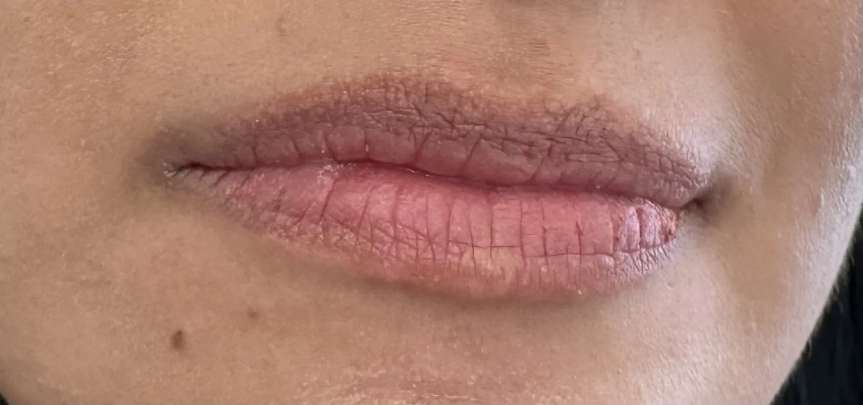 Antes — Filler de Labios