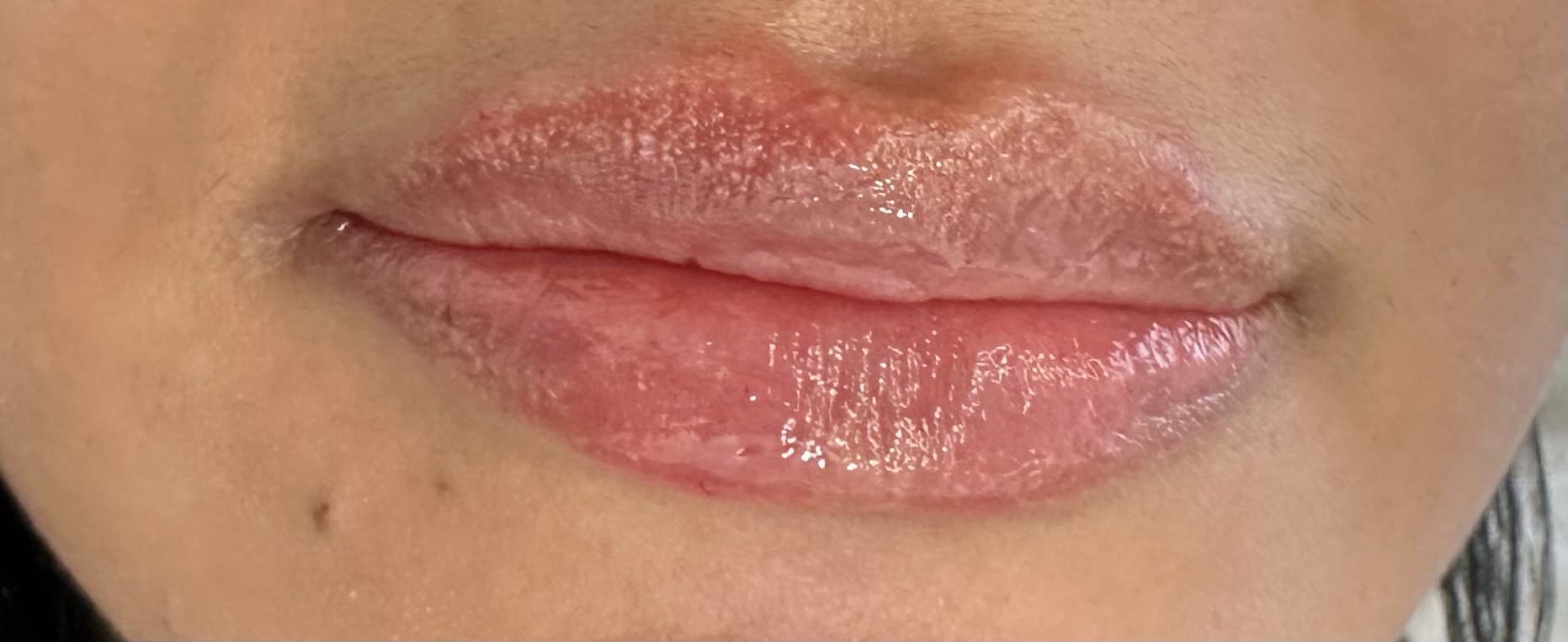 Después — Filler de Labios
