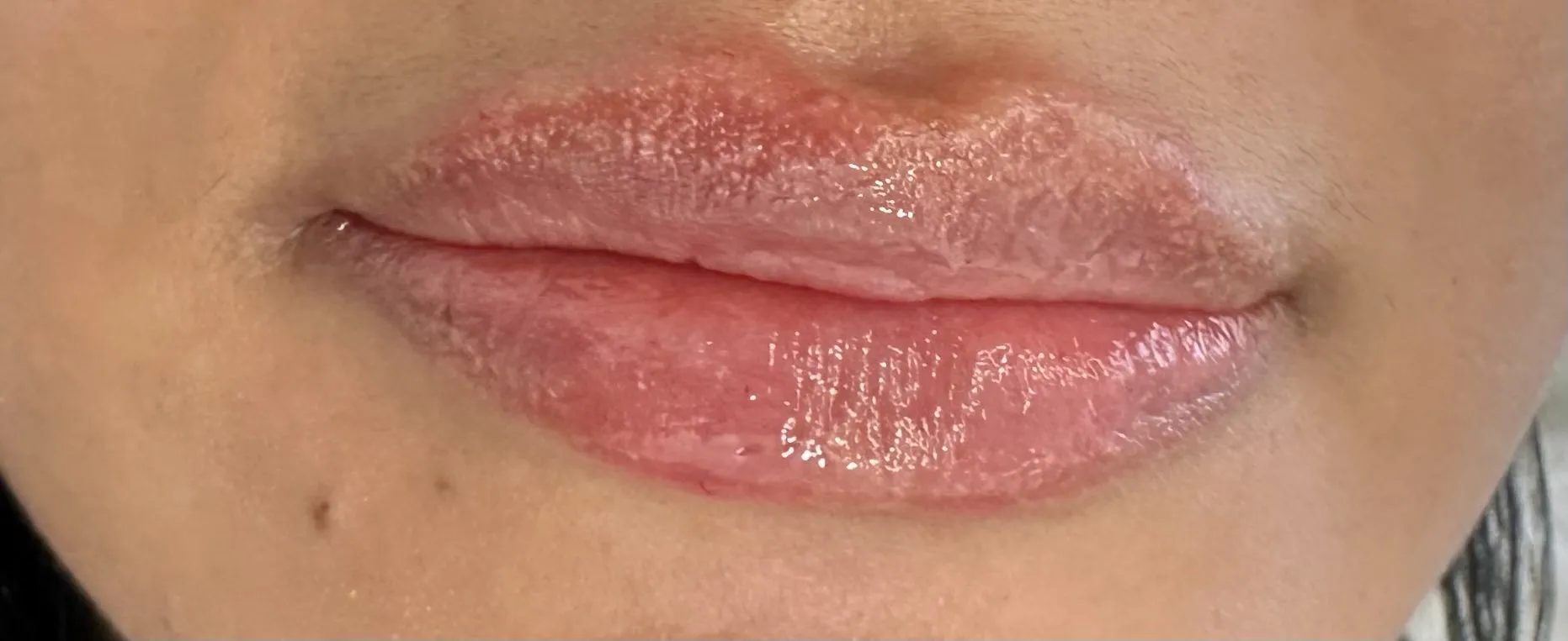 Después — Filler de Labios