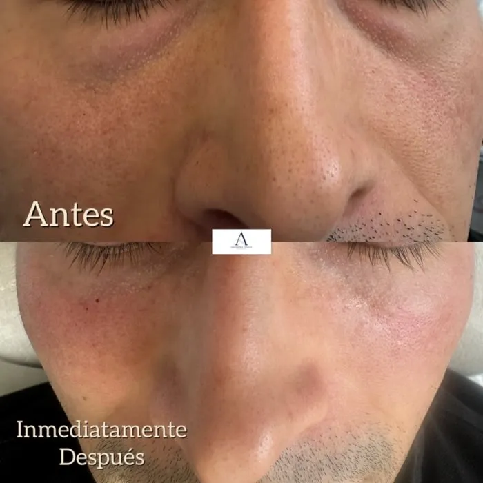 AH · Ojeras